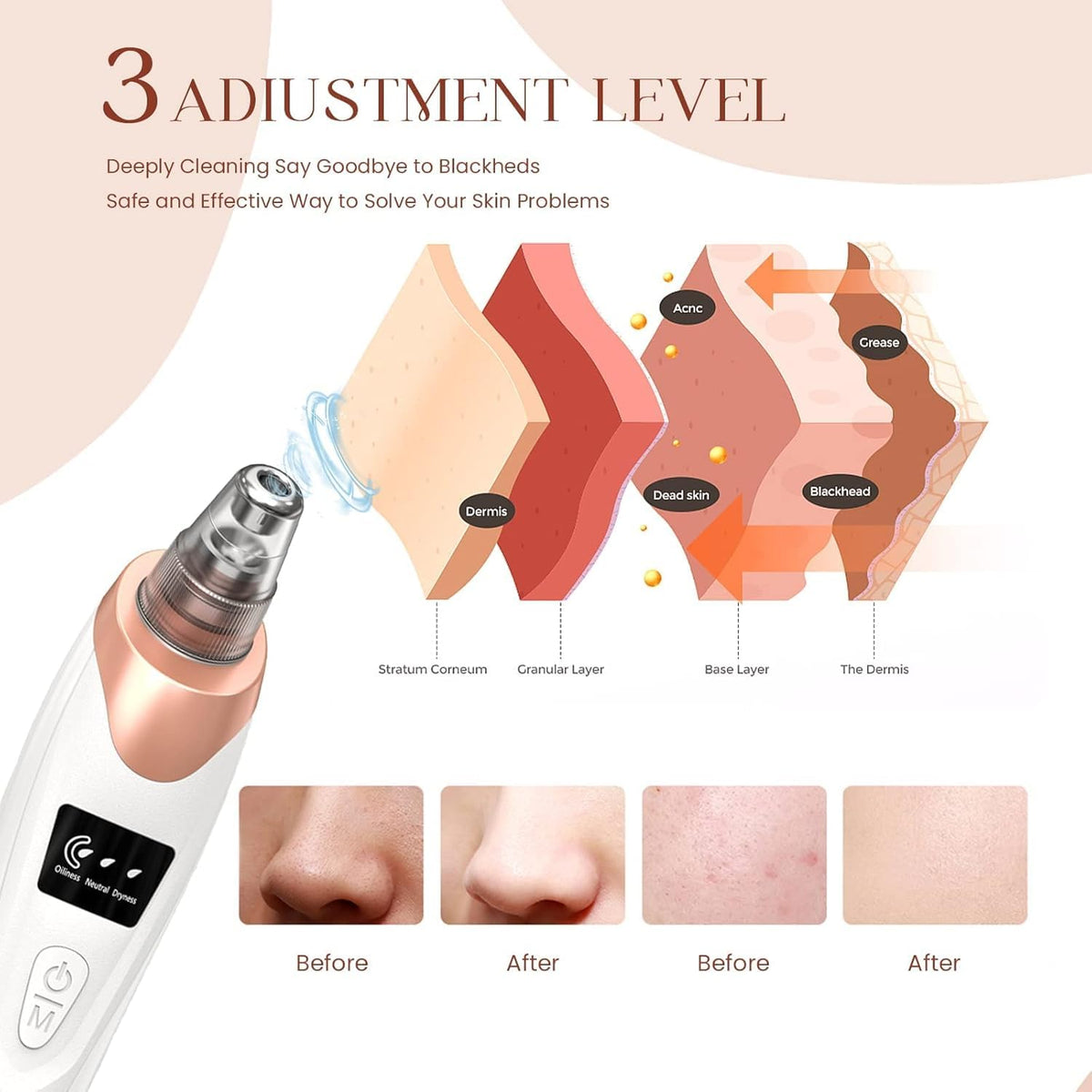Pore Vacuum Blackhead Remover,Facial Pore Cleaner, 5 Suction Power,5 Probes,USB Rechargeable Blackhead Vacuum Kit