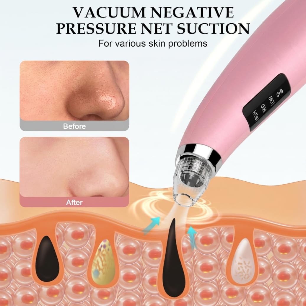 Blackhead Remover Pore Vacuum with 5 Attachments, 3 Suction Levels (Pink)