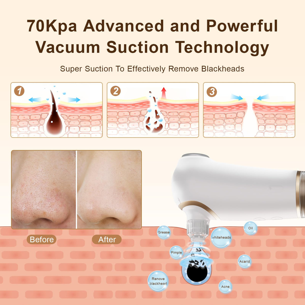Blackhead Remover Pore Vacuum with Cold and Hot Compress, Pore Vacuum
