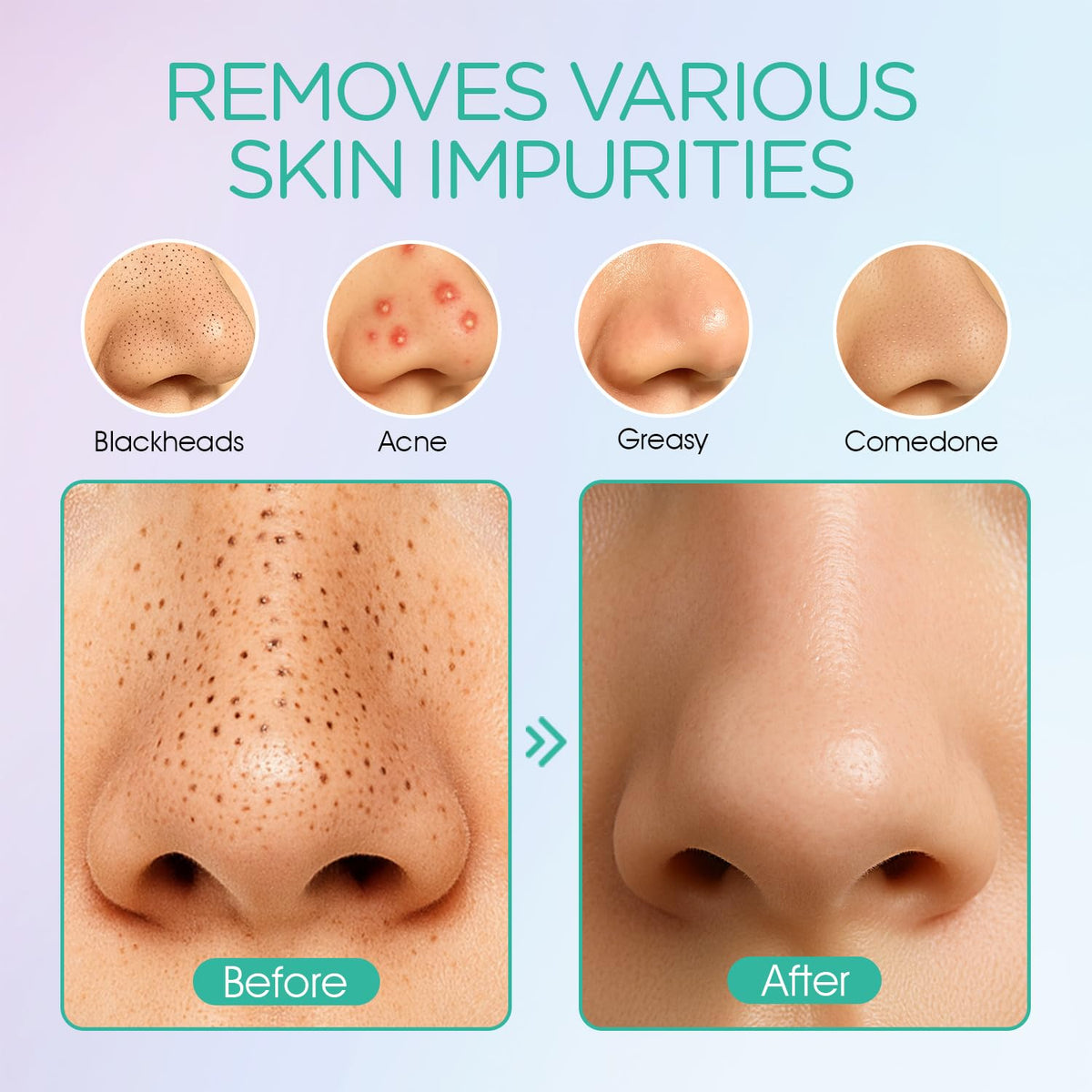 Blackhead Remover Pore Vacuum with 6 Suction Heads for Face