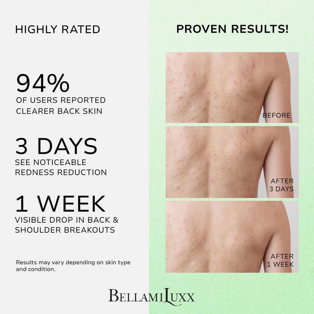 Back & Body Acne Treatment: 2% Salicylic Acid Back Acne Spray for Clear, Soothe & Moisturize - Effective Bacne