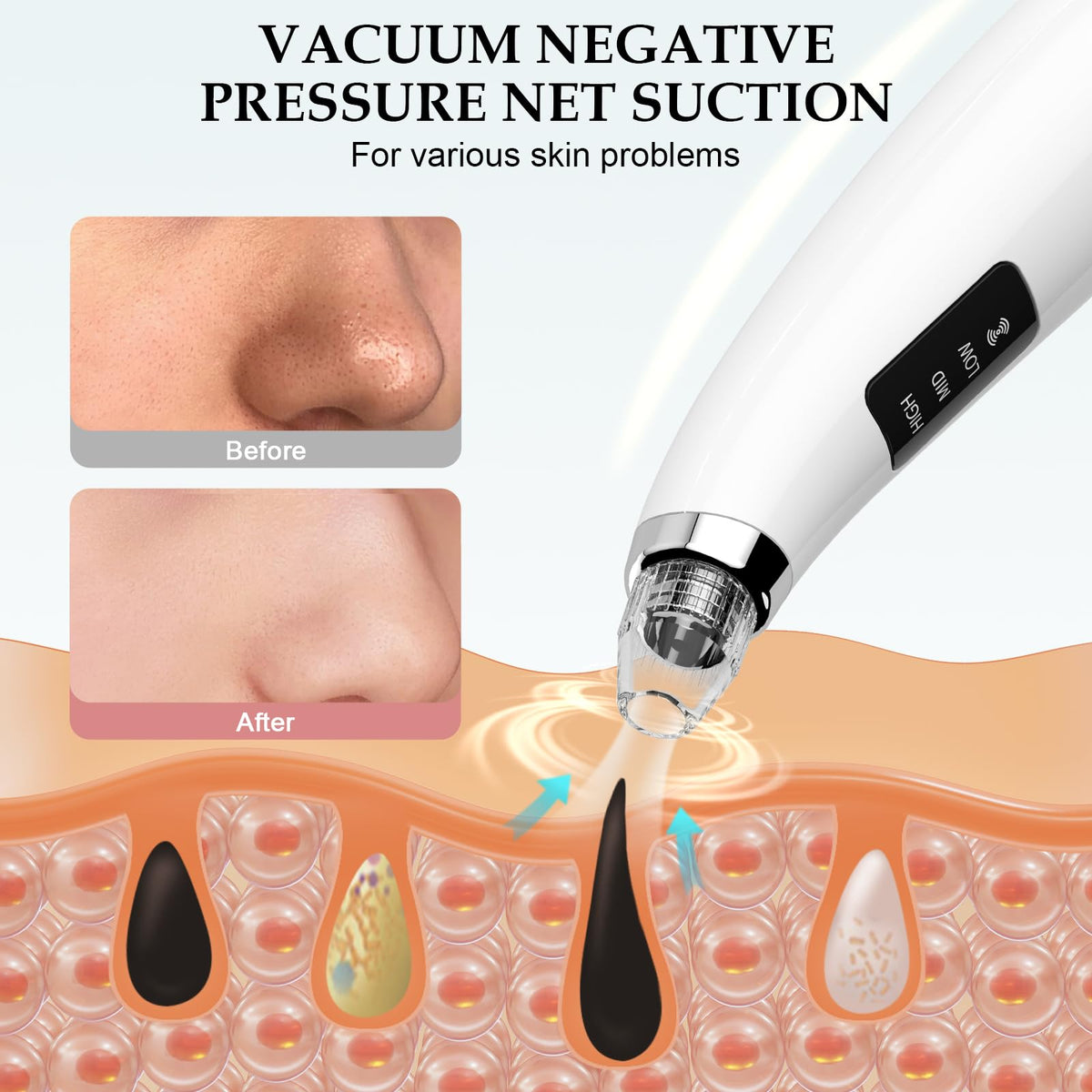 Blackhead Remover Pore Vacuum with 5 Attachments, 3 Suction Levels (White)