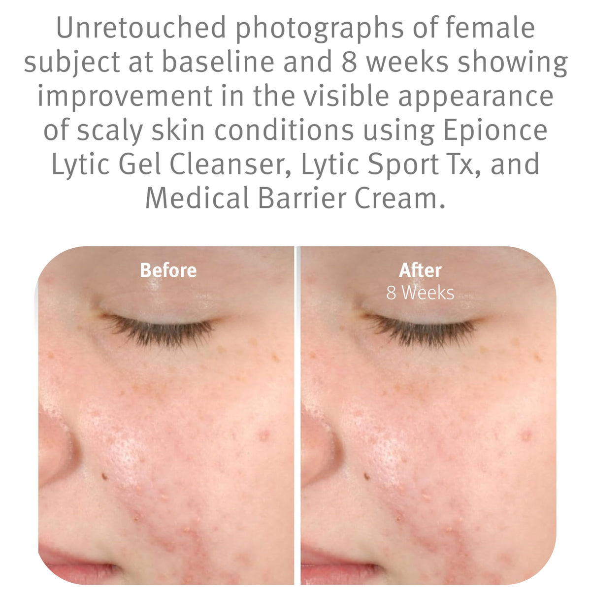Lytic Gel Cleanser Gentle Foaming Face Wash Blemish Makeup Remover