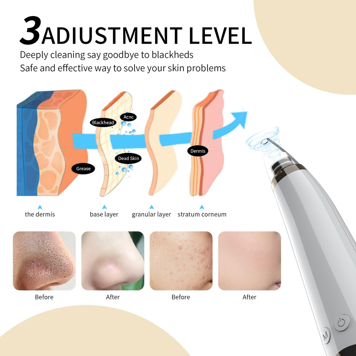 2026 Blackhead Remover Pore Vacuum Cleaner - 3 Adjustable Suction Power 6 Probes,USB Rechargeable Blackhead Vacuum