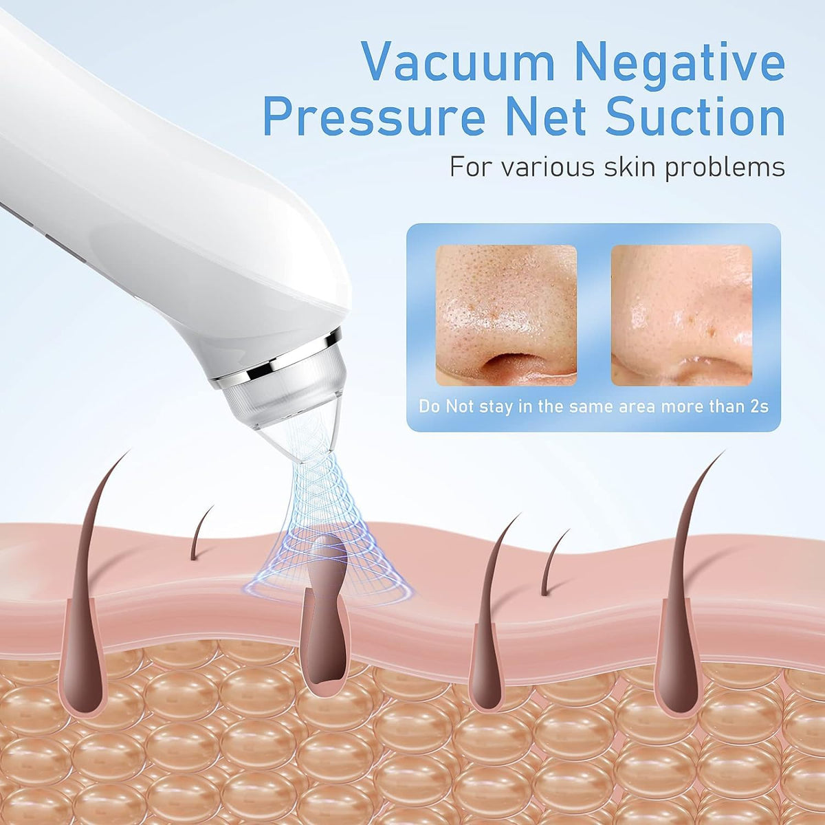 Blackhead Remover with Camera, 3 Levels, 6 Heads, USB Rechargeable