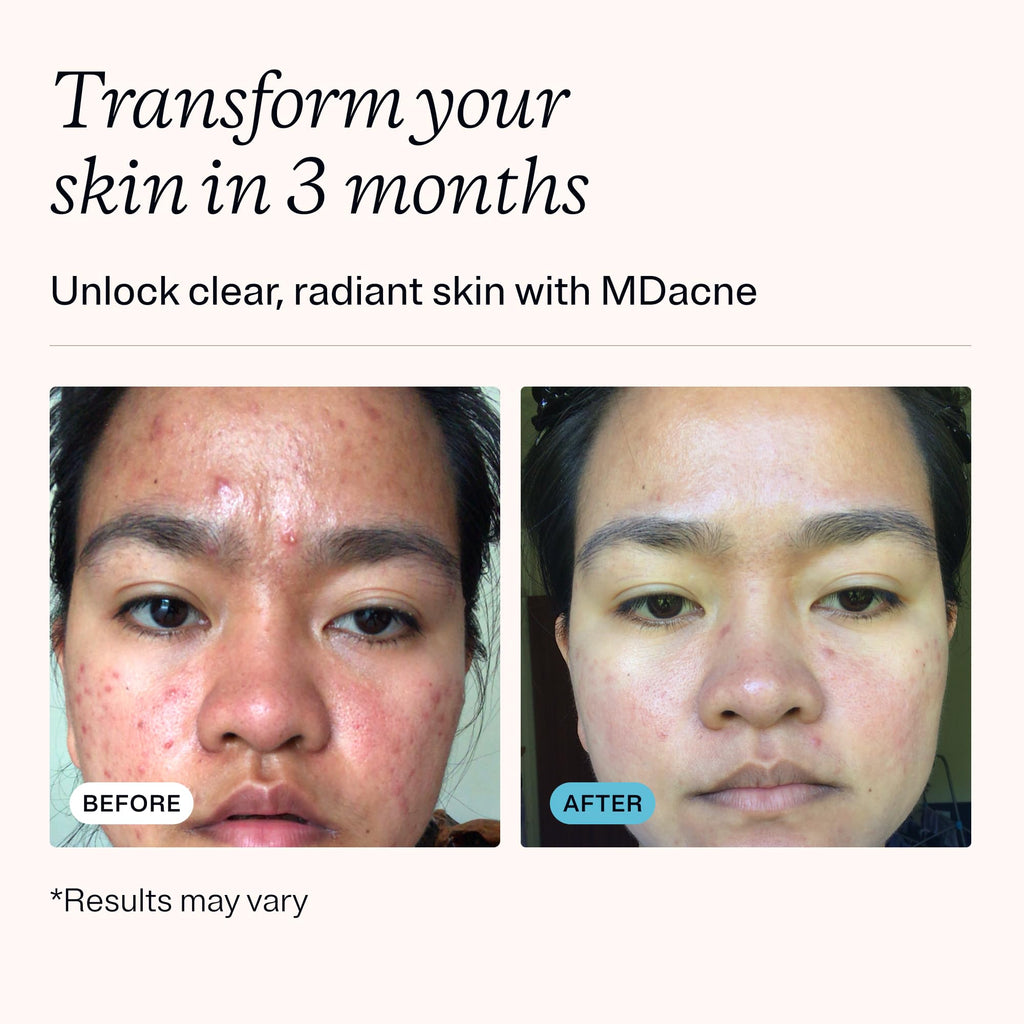 3-Step Acne Treatment Kit with Benzoyl Peroxide, 60 Day Supply