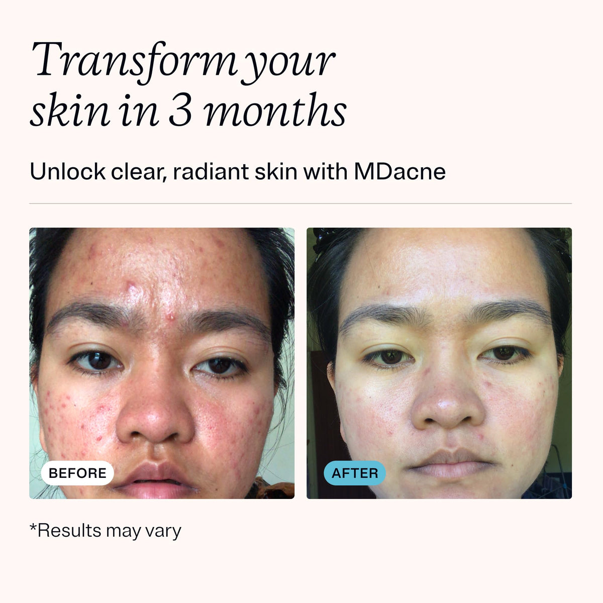 3-Step Acne Treatment Kit with Benzoyl Peroxide, 60 Day Supply