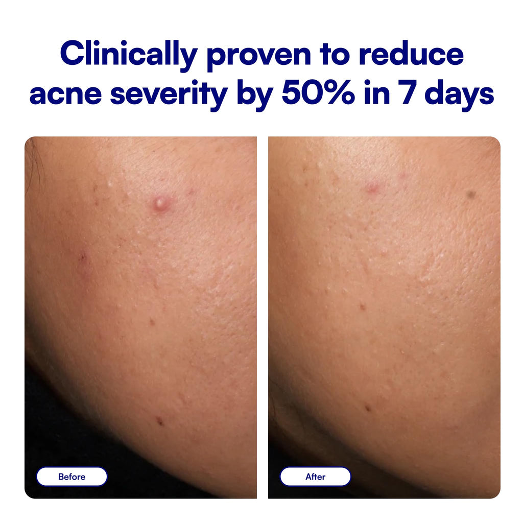 Clear Genius Salicylic Acid Acne Spot Treatment - 0.5 Oz - Non-Greasy