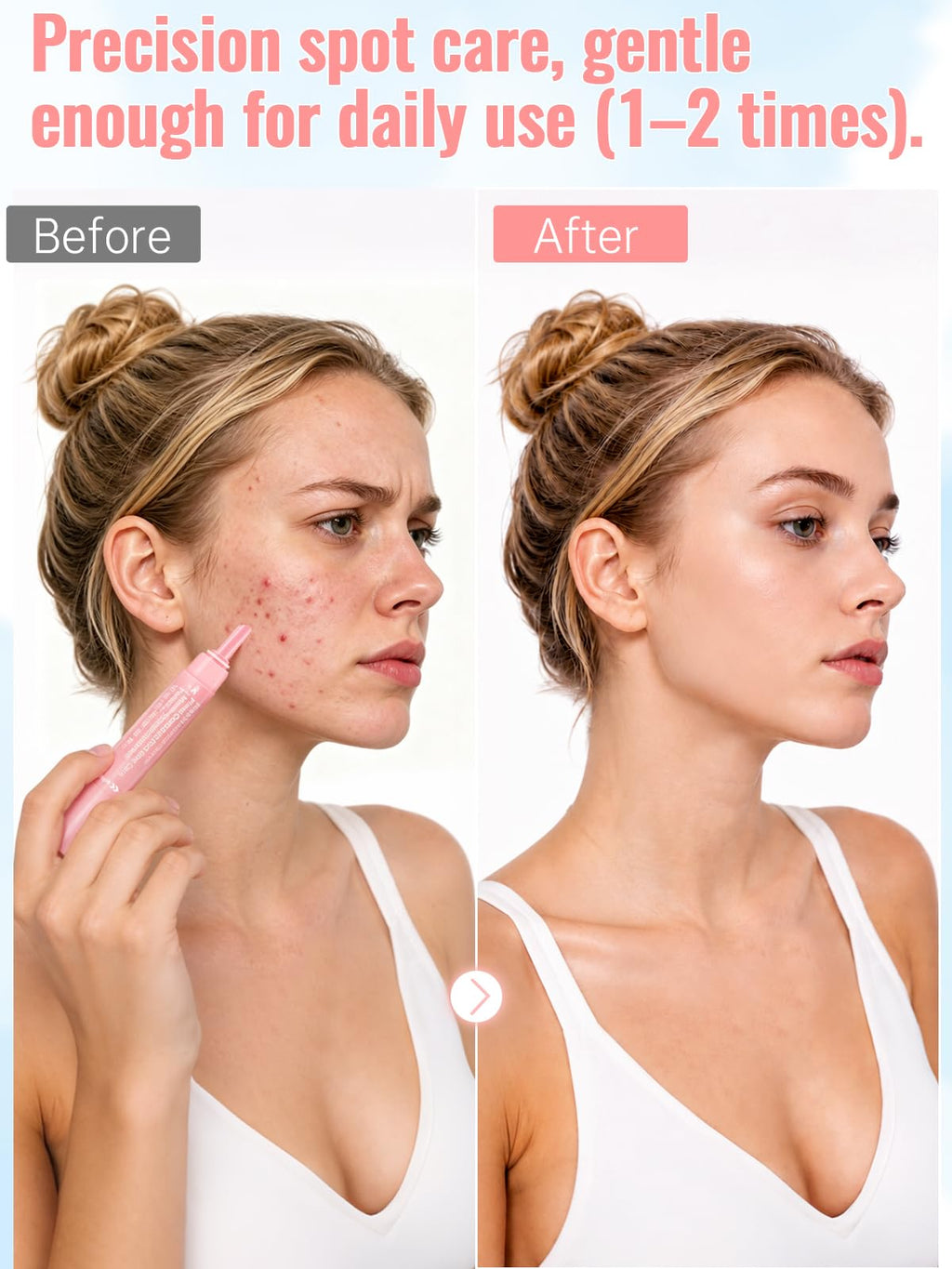Pimple Correct Acne Treatment Gel Pen 2% Salicylic Acid Maximum Strength