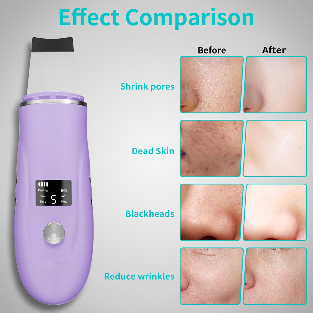 Face Scrubber Skin Spatula - Blackhead Remover Deep Cleansing Tool for Pore Extraction, 4-in-1 Fast Charging Dock
