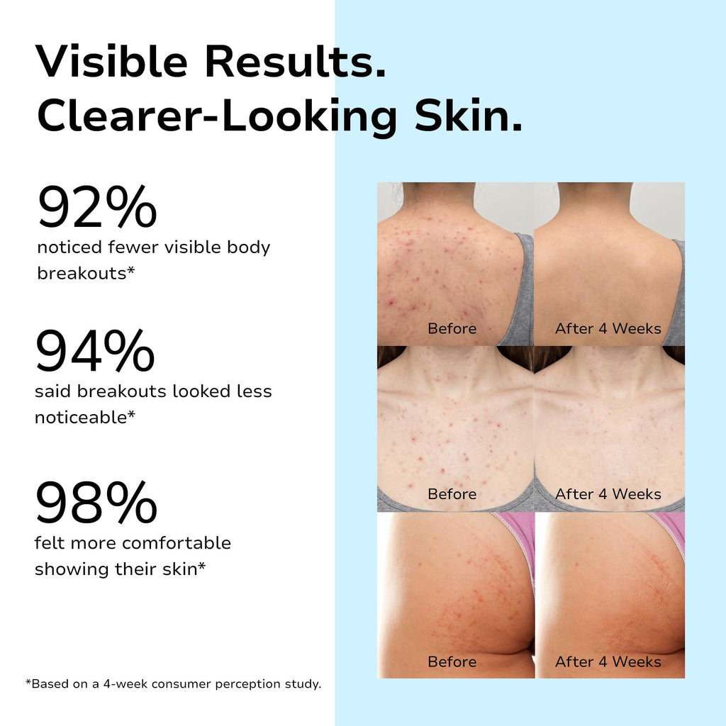 Benzoyl Peroxide Body Acne Wash: Body Acne Treatment Wash for Acne on Back, Chest, Butt & Folliculitis-Prone Skin –