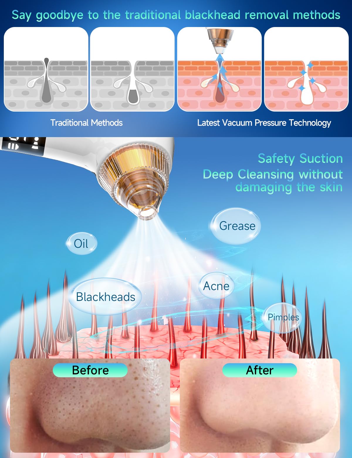 Upgraded Visible Blackhead Remover Pore Vacuum,5 Suction Levels,6 Probes