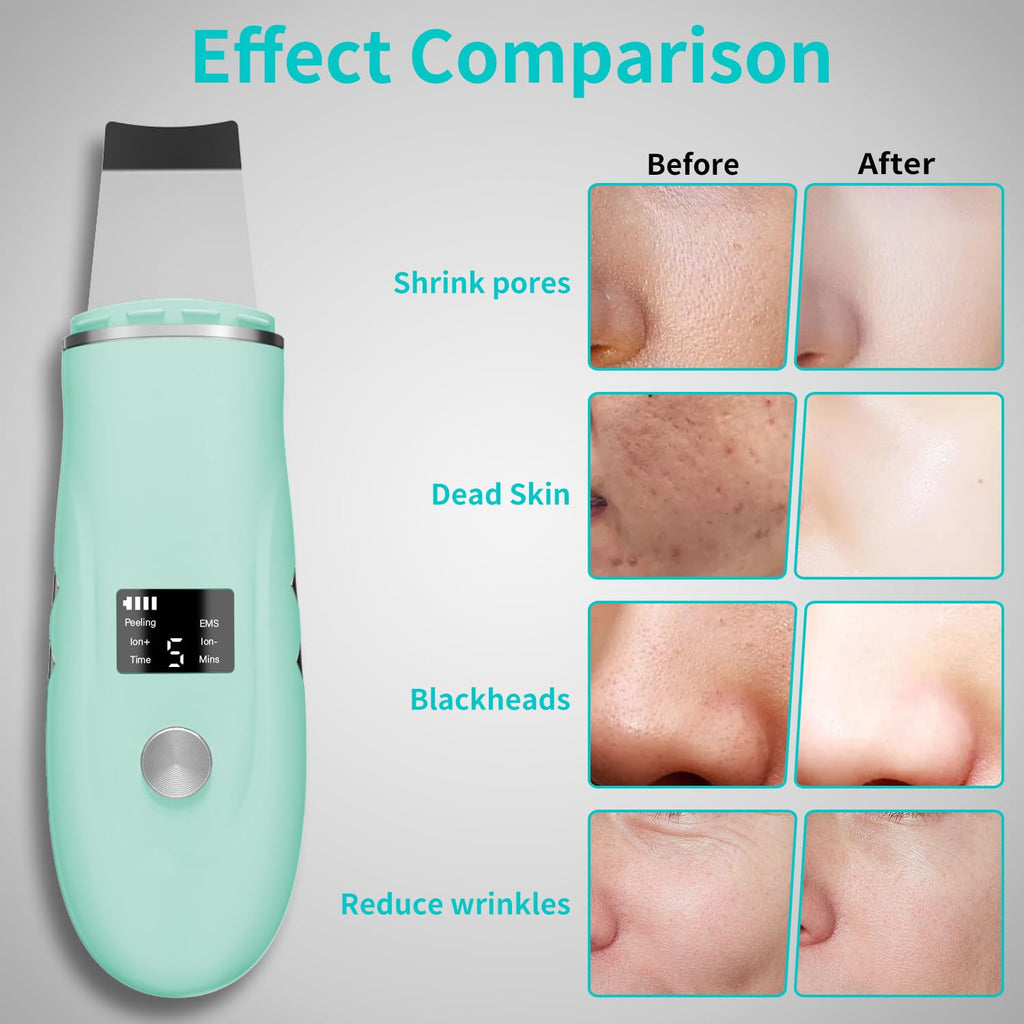 Face Scrubber Skin Spatula - Blackhead Remover Deep Cleansing Tool for Pore Extraction, 4-in-1 Fast Charging Dock