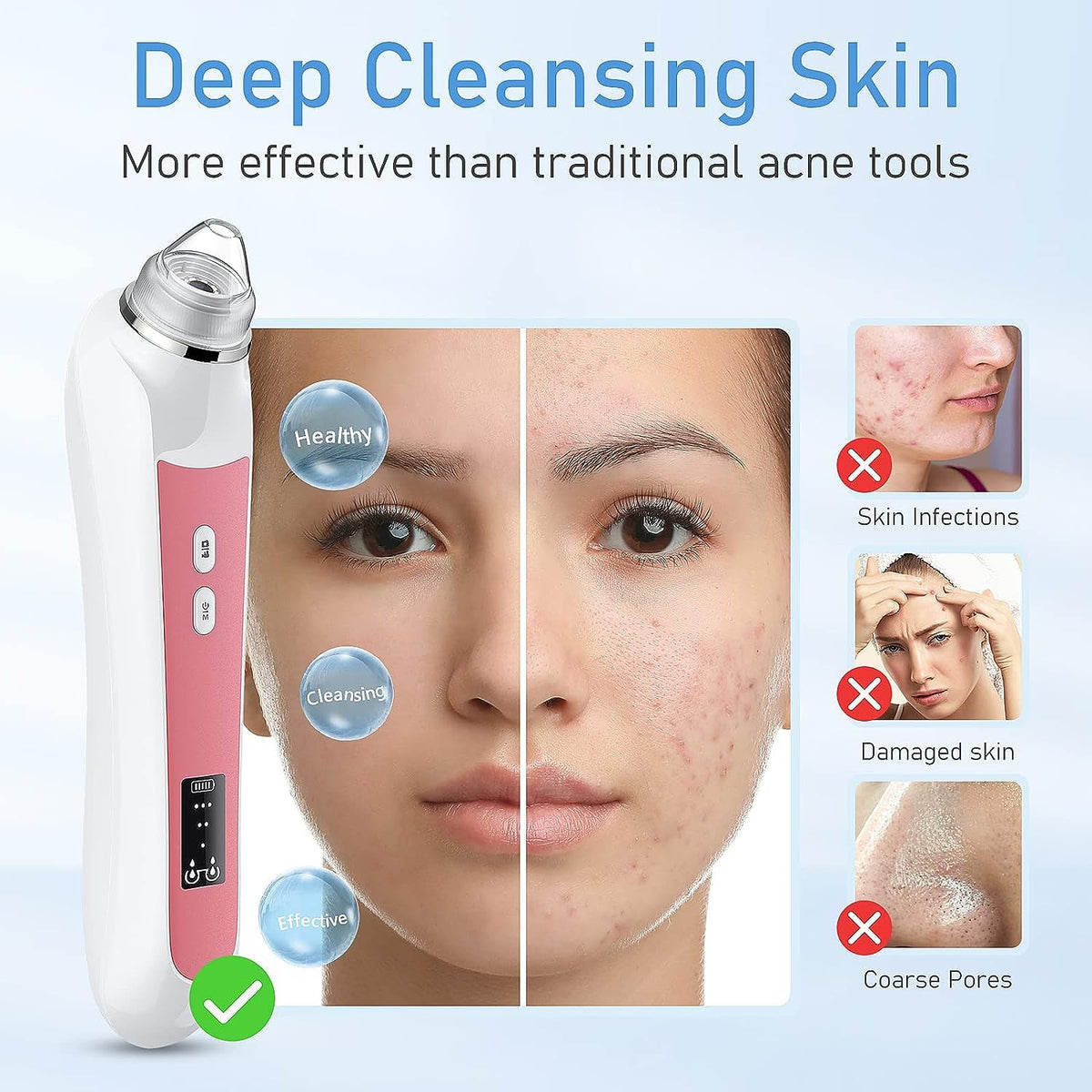 Blackhead Remover with Camera, 3 Levels, 6 Heads, USB Rechargeable