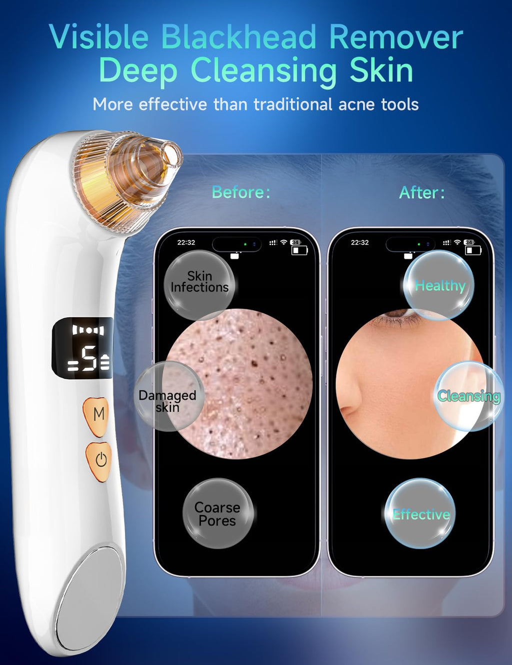 Upgraded Visible Blackhead Remover Pore Vacuum,5 Suction Levels,6 Probes