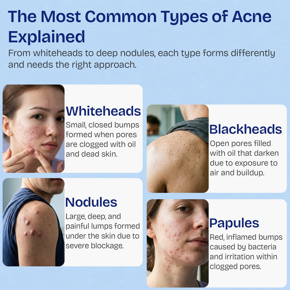 Body Acne Spray | Back Acne Treatment for Face, Body, Shoulder & Butt | Acne Body Spray for Blackheads & Whiteheads