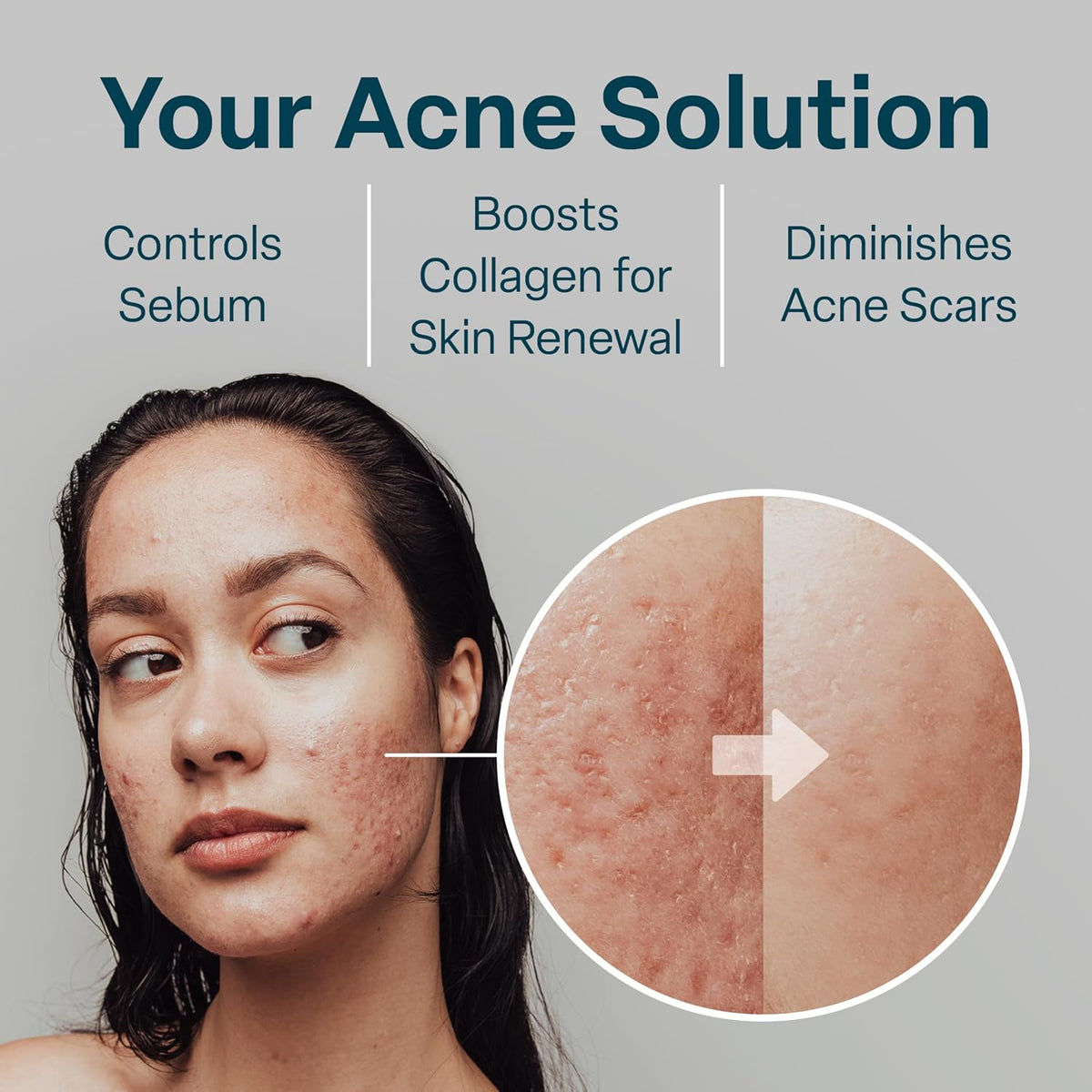Salicylic & Glycolic Acid Acne Clearing Pads - 2% Salicylic & 10% Glycolic Acid - Exfoliating Pads for Acne, Bacne