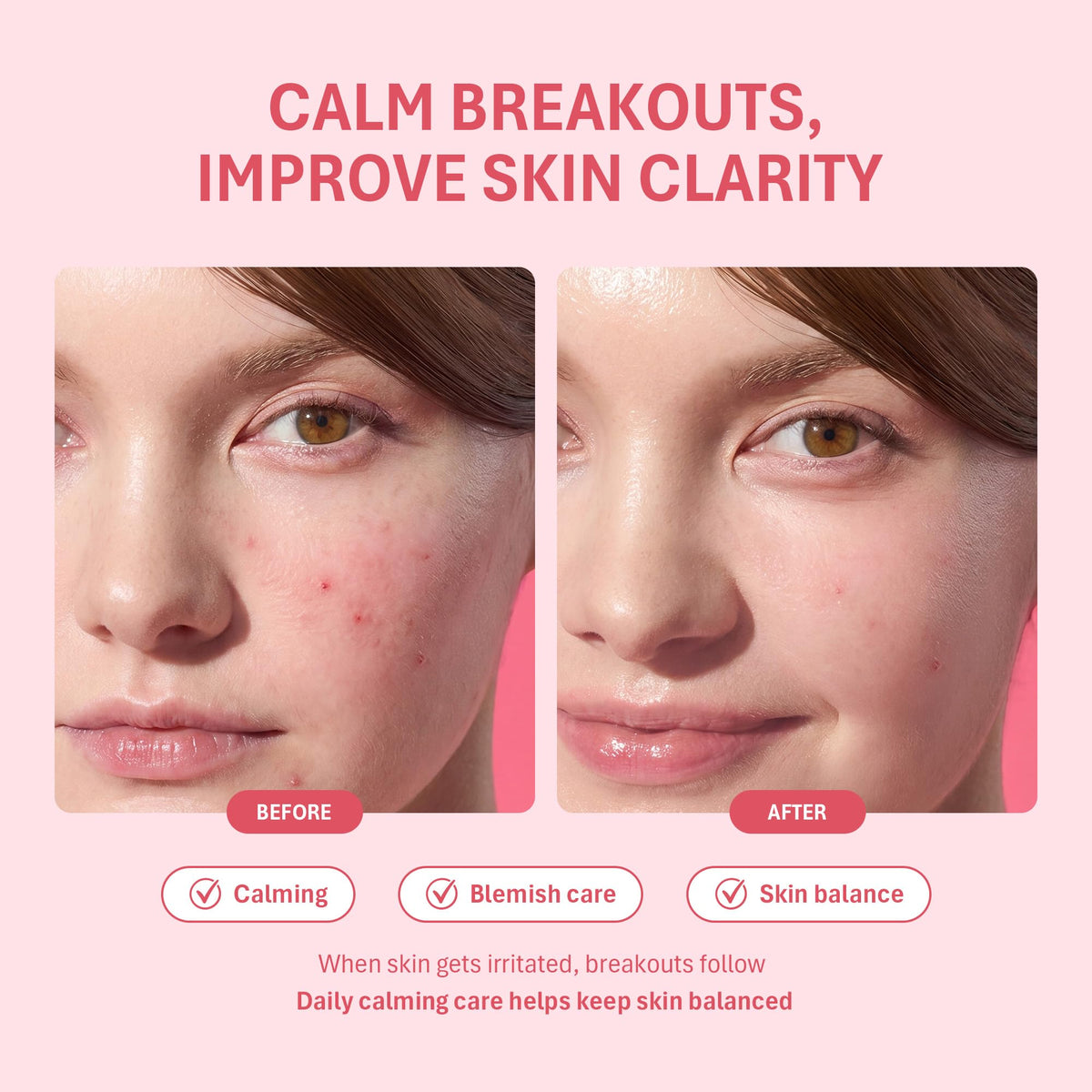 Salicylic Acid Acne Spot Treatment for Face, 0.67 fl.oz.